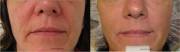 face lift with botox dermal fillers