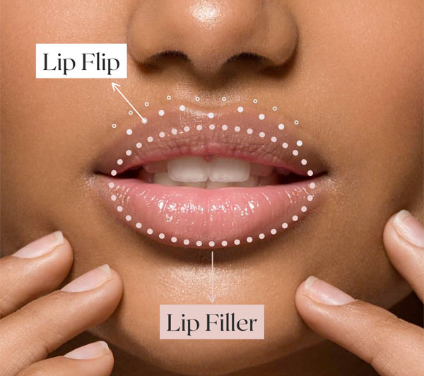lip filler vs lip flip