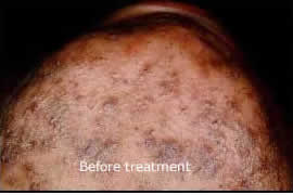 Laser Ingrown Hair Beard Razor Bump Removal Westchester, Stamford