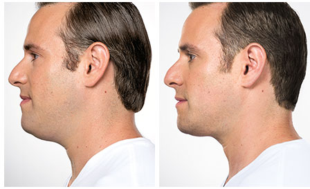Kybella treatment for double chin, reduced neckline, NYC