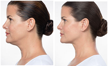 Non-Invasive Double Chin Reduction