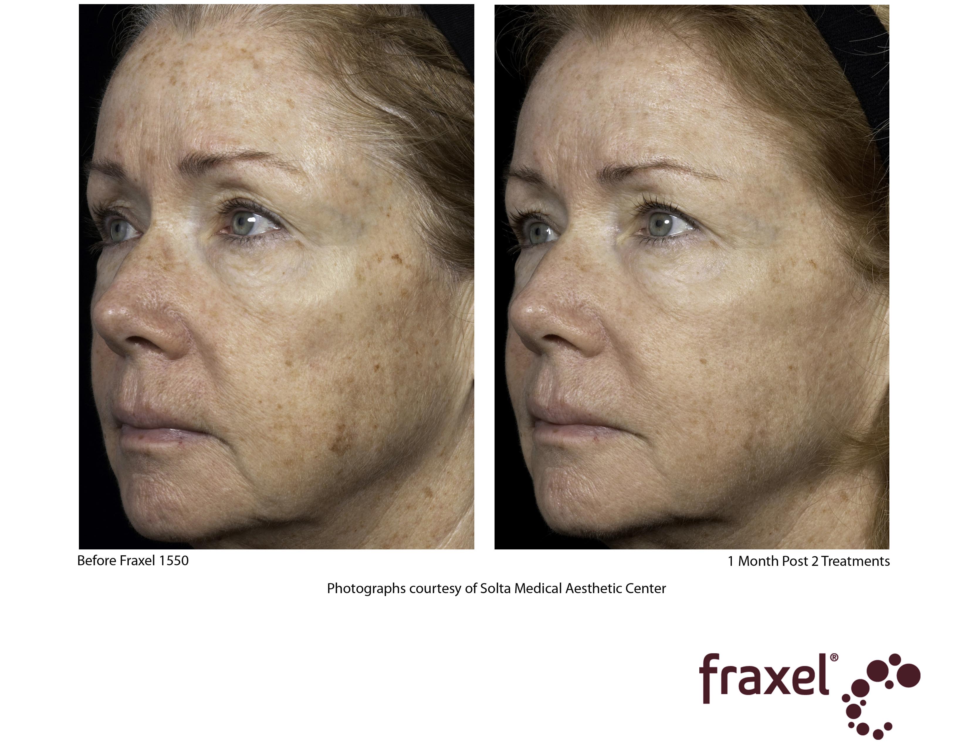 Fraxel Laser Treatment, Cost & Results